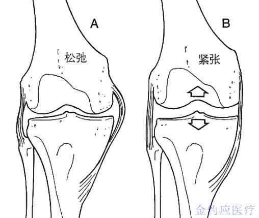 关节资讯-全膝关节置换术