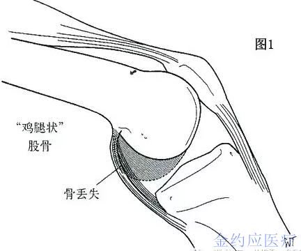 不稳定和畸形的处理(六):屈曲挛缩(下篇)