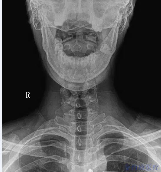 颈椎不适?x光片应该这样读!