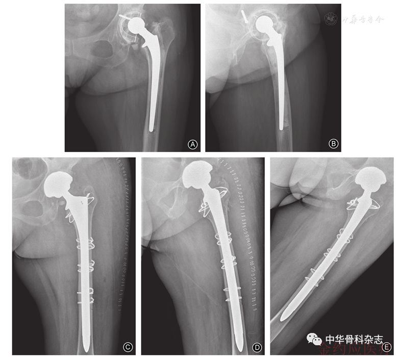 髋关节翻修术中股骨假体松动后股骨髓腔变形的矫正