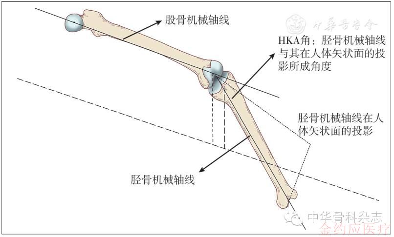 全膝关节置换中股骨外旋截骨对下肢动态力线的影响