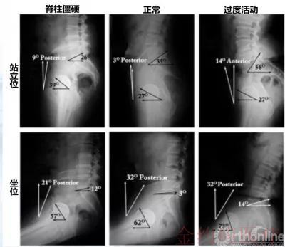 脊柱 骨盆矢状面平衡 髋关节外科的新视角 张洪教授 金约应医疗